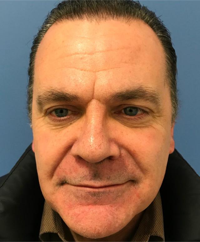 Botox before at Renew Aesthetic & Laser Clinic in Portland in Portland, OR
