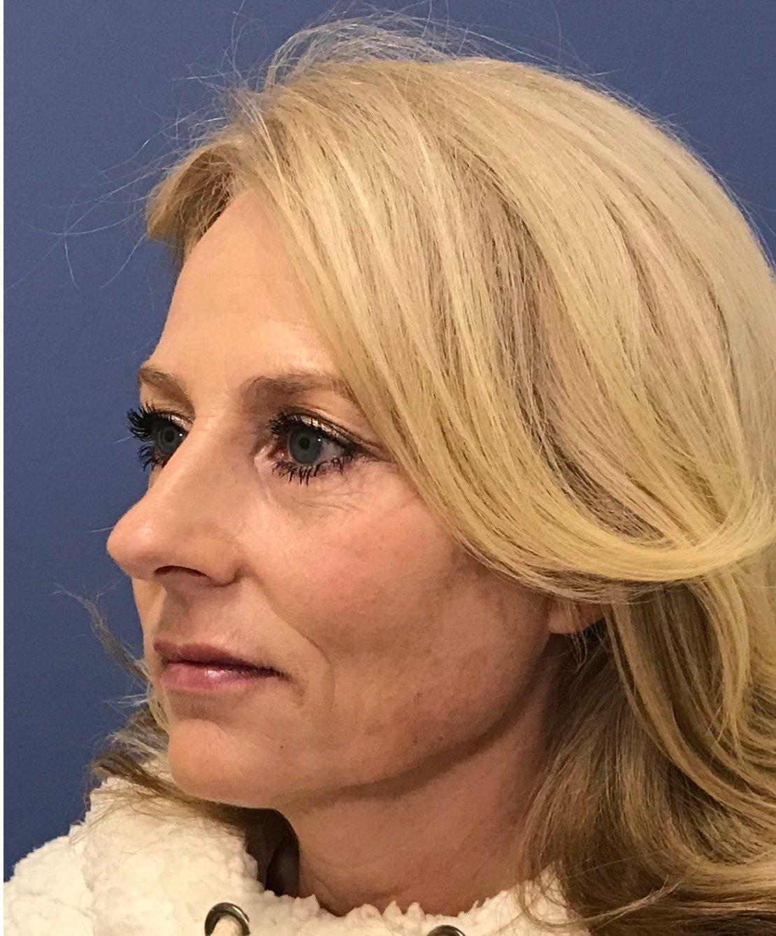 Renew Aesthetic & Laser Clinic in Portland after — Portland, OR