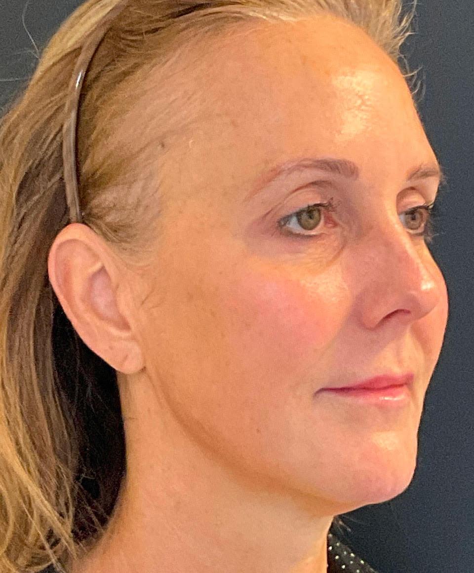 Renew Aesthetic & Laser Clinic in Portland after — Portland, OR