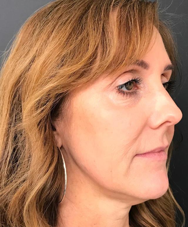 Facelift before at Renew Aesthetic & Laser Clinic in Portland in Portland, OR