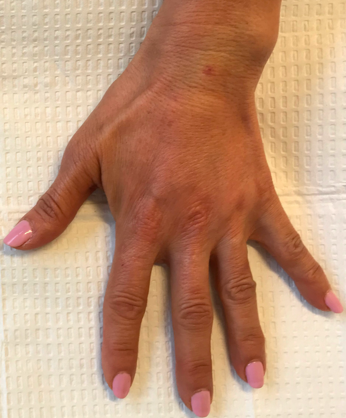 Renew Aesthetic & Laser Clinic in Portland after — Portland, OR