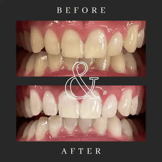 Teeth Whitening result at Optimal Health Family Practice & Medspa in Provo, UT