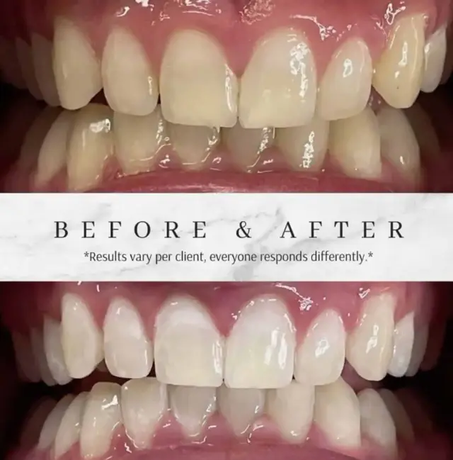 Teeth Whitening result at Optimal Health Family Practice & Medspa in Provo, UT