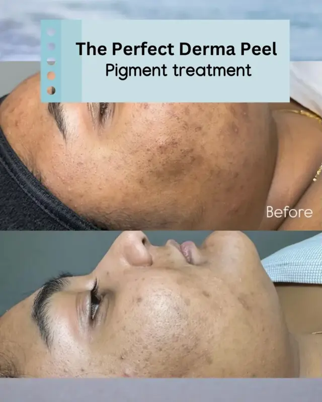 Morpheus8 result at Optimal Health Family Practice & Medspa in Provo, UT