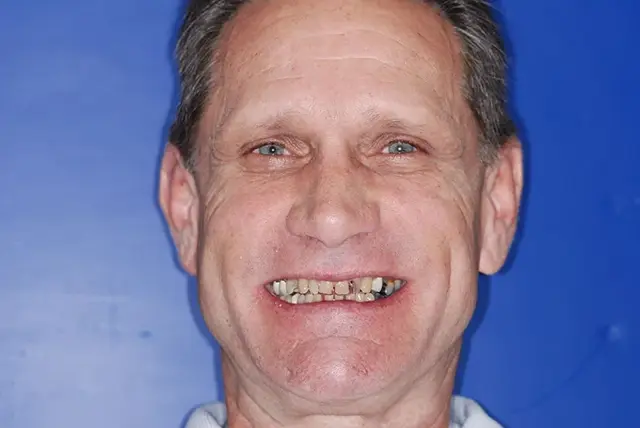 Dental Implants before at My Dentist in Plano in Plano, TX