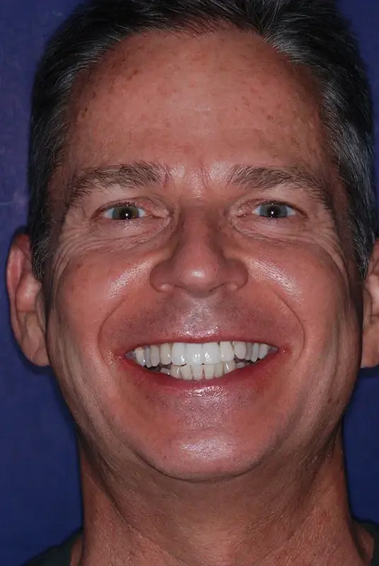 Dental Veneers after at My Dentist in Plano in Plano, TX