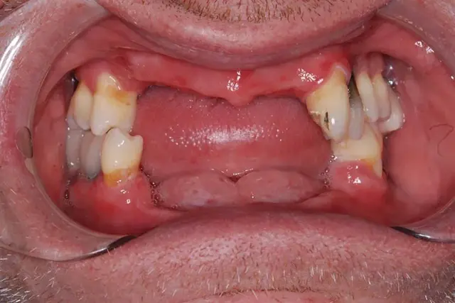Dental Implants before at My Dentist in Plano in Plano, TX