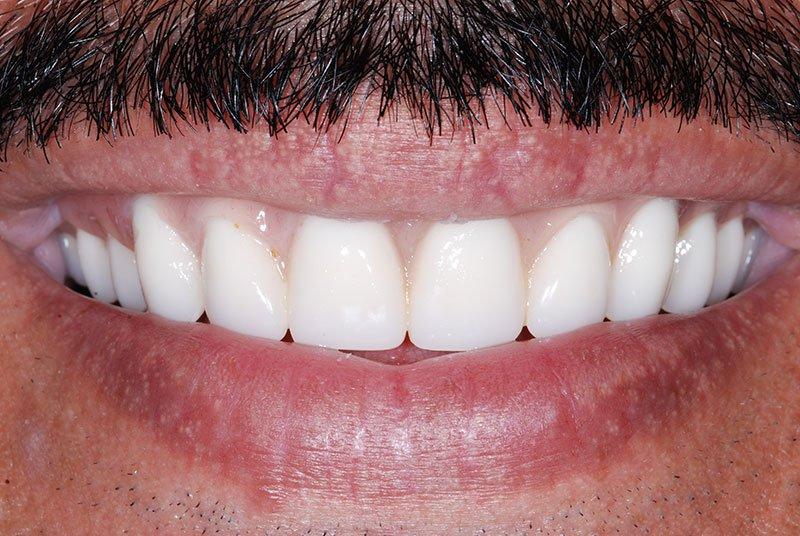 My Dentist in Plano smile makeover after — Plano, TX