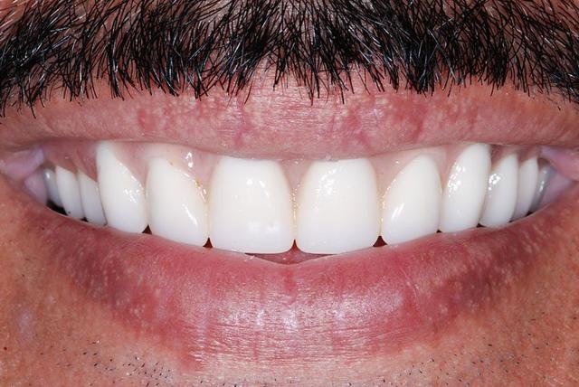Smile Makeover after at My Dentist in Plano in Plano, TX