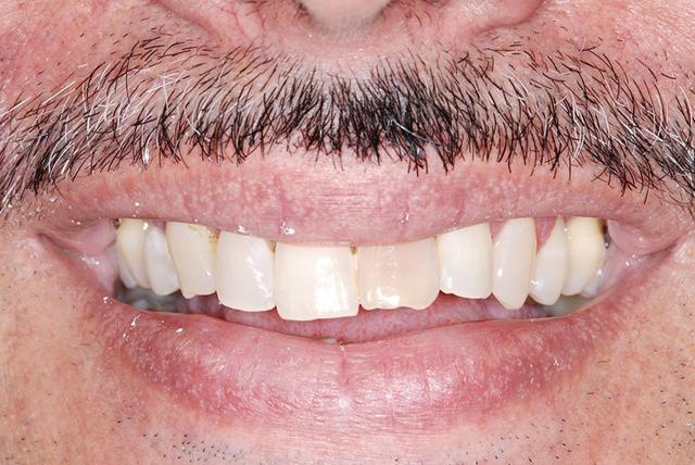Smile Makeover before at My Dentist in Plano in Plano, TX