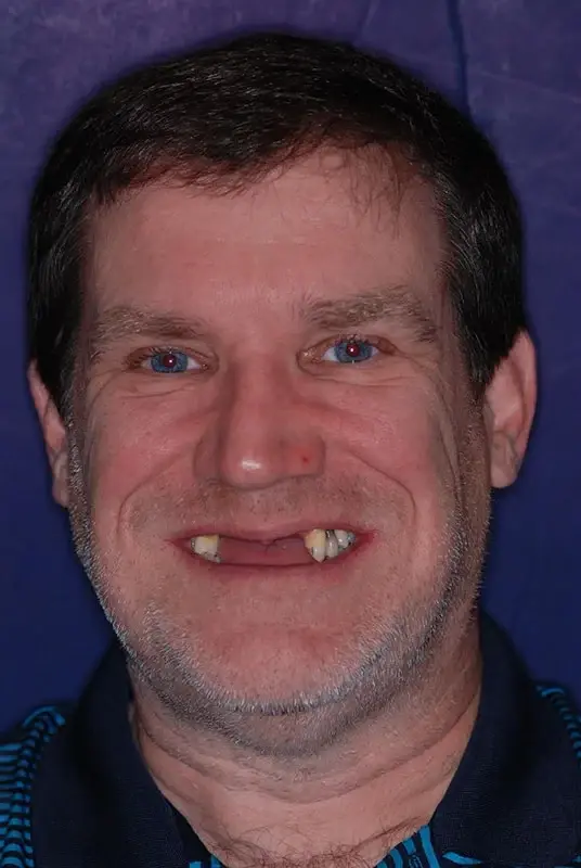 Dental Implants before at My Dentist in Plano in Plano, TX