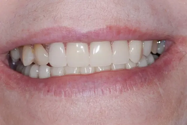 Dental Veneers after at My Dentist in Plano in Plano, TX