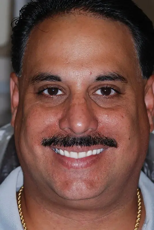 Dental Implants after at My Dentist in Plano in Plano, TX