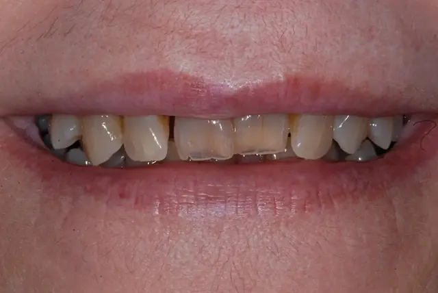 Dental Veneers before at My Dentist in Plano in Plano, TX
