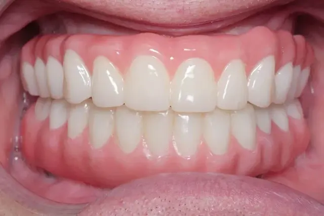 Dental Implants after at My Dentist in Plano in Plano, TX