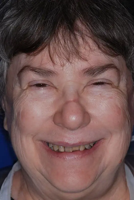Dental Implants before at My Dentist in Plano in Plano, TX