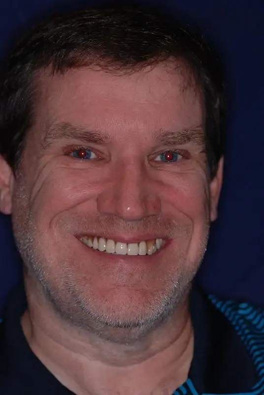 Dental Implants after at My Dentist in Plano in Plano, TX