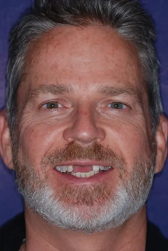 Dental Veneers before at My Dentist in Plano in Plano, TX