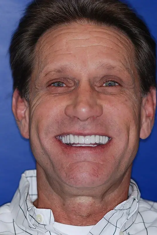 Dental Implants after at My Dentist in Plano in Plano, TX