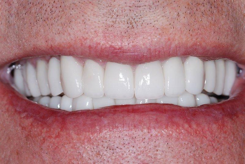 My Dentist in Plano smile makeover after — Plano, TX