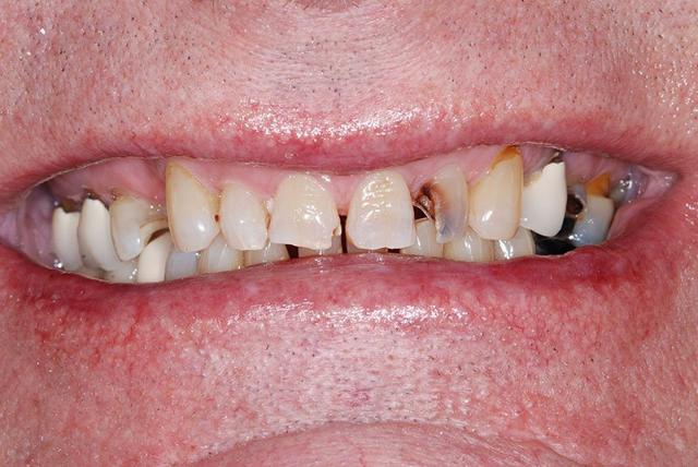 Smile Makeover before at My Dentist in Plano in Plano, TX