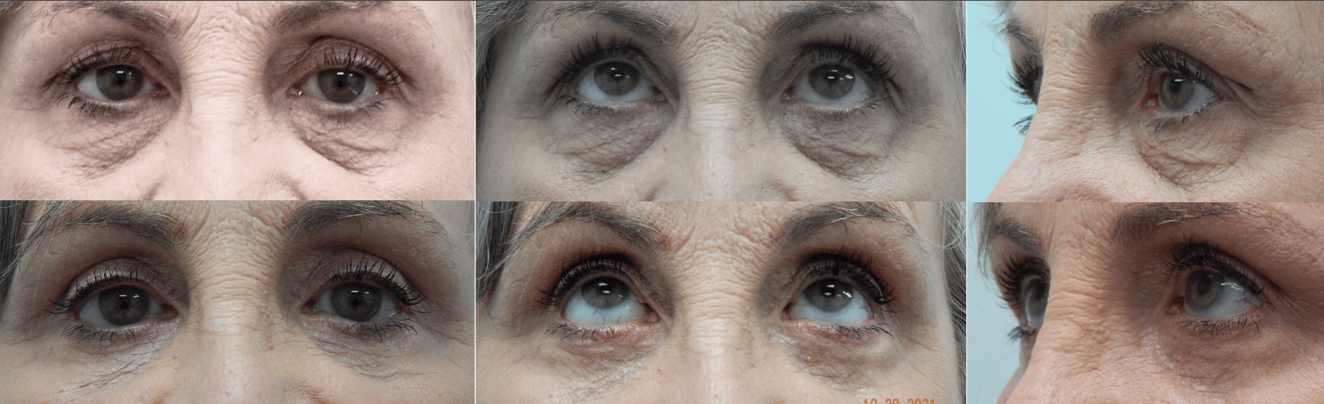 Fort Lauderdale Plastic Surgery blepharoplasty result — Fort Lauderdale, FL