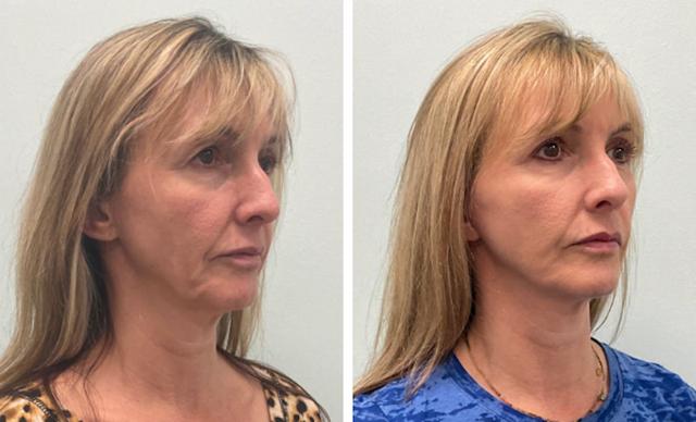 Mini Facelift result at Fort Lauderdale Plastic Surgery in Fort Lauderdale, FL