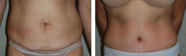 Tummy Tuck result at Fort Lauderdale Plastic Surgery in Fort Lauderdale, FL