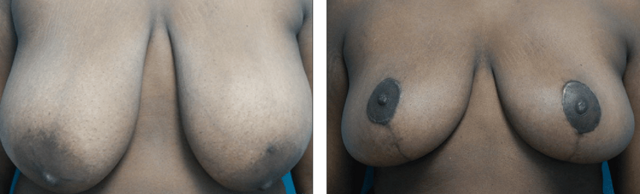 Breast Reduction result at Fort Lauderdale Plastic Surgery in Fort Lauderdale, FL