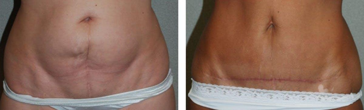 Fort Lauderdale Plastic Surgery tummy tuck result — Fort Lauderdale, FL