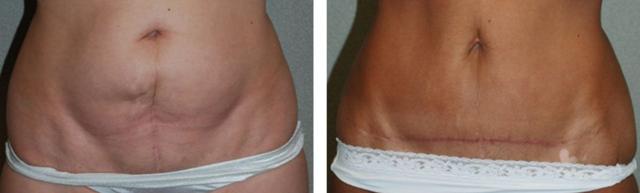 Tummy Tuck result at Fort Lauderdale Plastic Surgery in Fort Lauderdale, FL