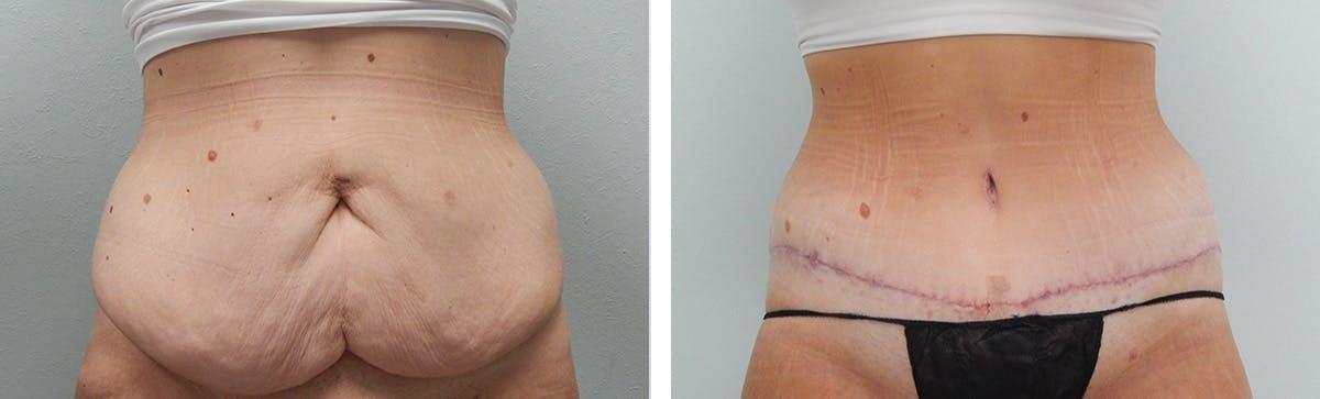 Fort Lauderdale Plastic Surgery tummy tuck result — Fort Lauderdale, FL