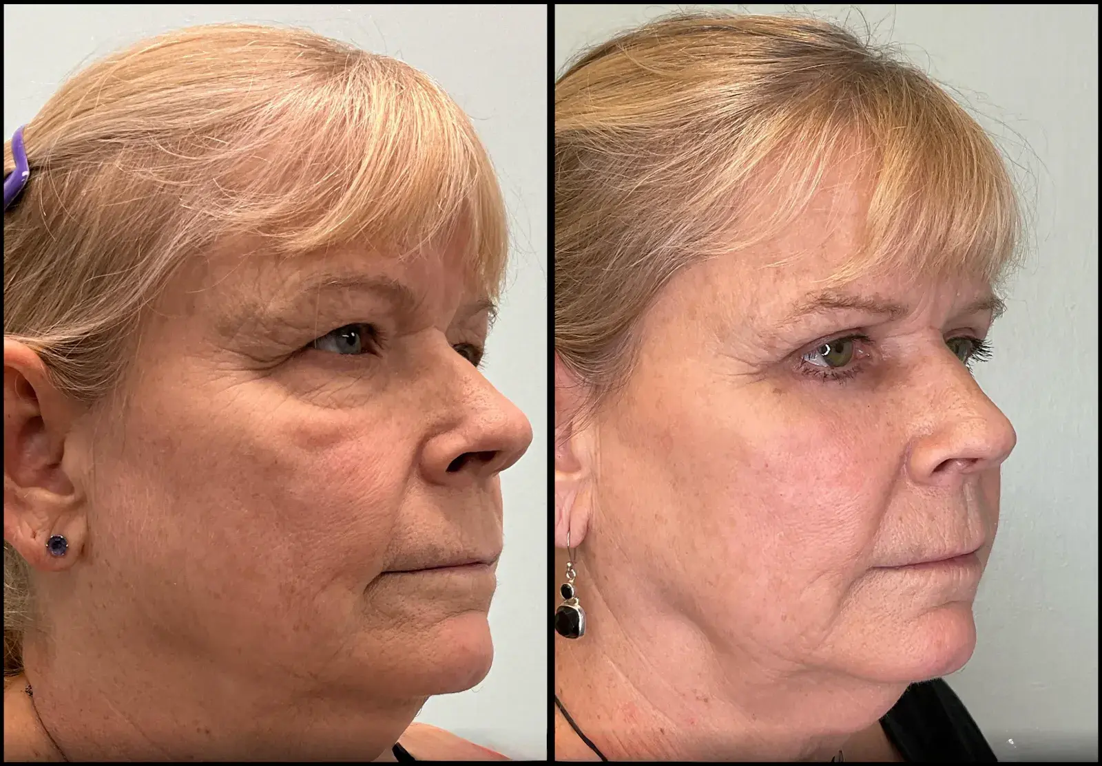 Fort Lauderdale Plastic Surgery eyelid lift result — Fort Lauderdale, FL