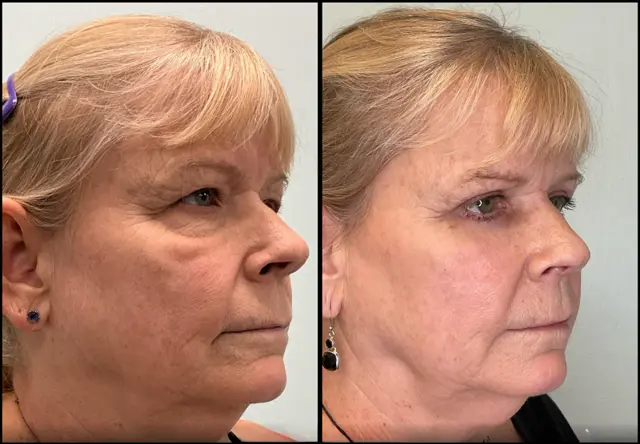 Blepharoplasty result at Fort Lauderdale Plastic Surgery in Fort Lauderdale, FL