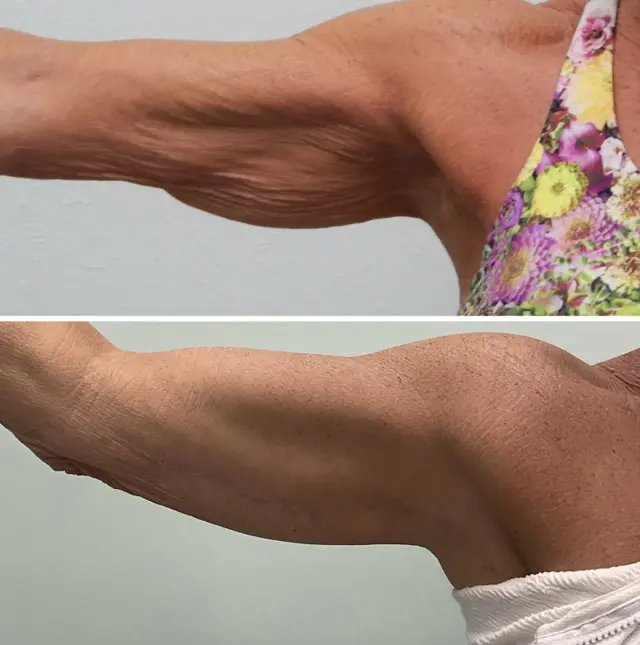 Arm Lift result at Fort Lauderdale Plastic Surgery in Fort Lauderdale, FL