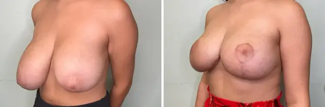 Breast Reduction result at Fort Lauderdale Plastic Surgery in Fort Lauderdale, FL