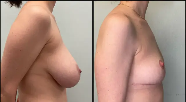 Breast Reduction result at Fort Lauderdale Plastic Surgery in Fort Lauderdale, FL