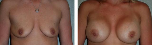Breast Augmentation result at Fort Lauderdale Plastic Surgery in Fort Lauderdale, FL