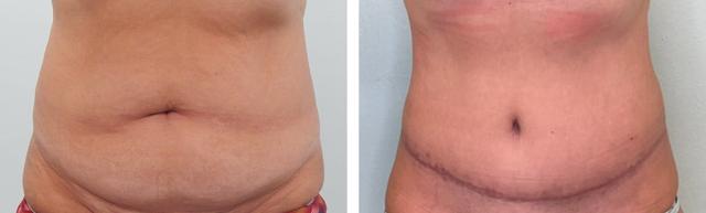 Liposuction result at Fort Lauderdale Plastic Surgery in Fort Lauderdale, FL