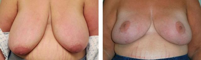 Breast Reduction result at Fort Lauderdale Plastic Surgery in Fort Lauderdale, FL