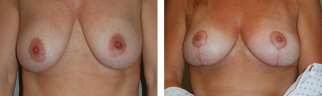 Breast Lift result at Fort Lauderdale Plastic Surgery in Fort Lauderdale, FL
