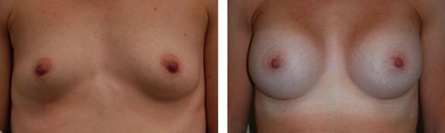 Breast Augmentation result at Fort Lauderdale Plastic Surgery in Fort Lauderdale, FL