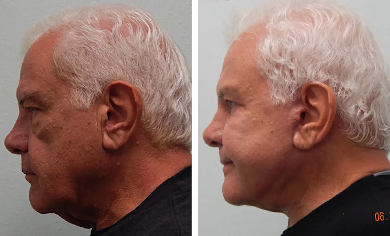 Fort Lauderdale Plastic Surgery eyelid lift result — Fort Lauderdale, FL