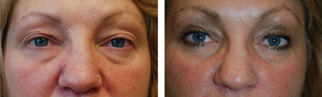 Blepharoplasty result at Fort Lauderdale Plastic Surgery in Fort Lauderdale, FL