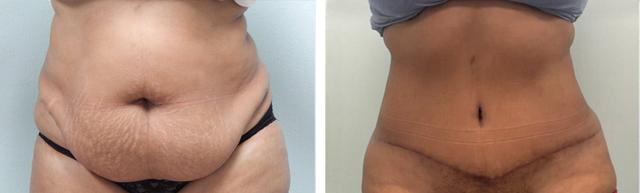 Liposuction result at Fort Lauderdale Plastic Surgery in Fort Lauderdale, FL