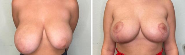 Breast Lift result at Fort Lauderdale Plastic Surgery in Fort Lauderdale, FL