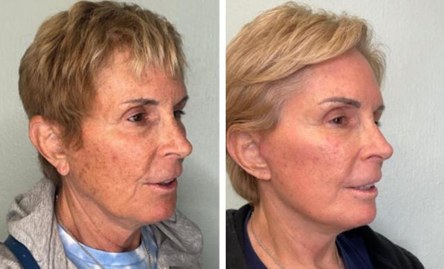 Mini Facelift result at Fort Lauderdale Plastic Surgery in Fort Lauderdale, FL