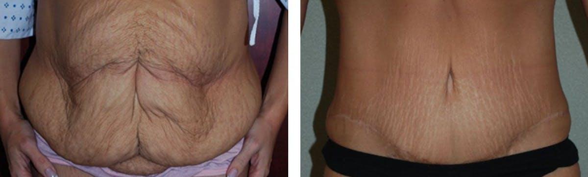 Fort Lauderdale Plastic Surgery tummy tuck result — Fort Lauderdale, FL