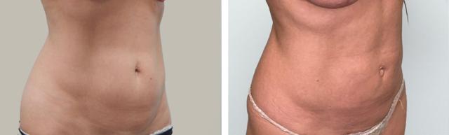 Liposuction result at Fort Lauderdale Plastic Surgery in Fort Lauderdale, FL