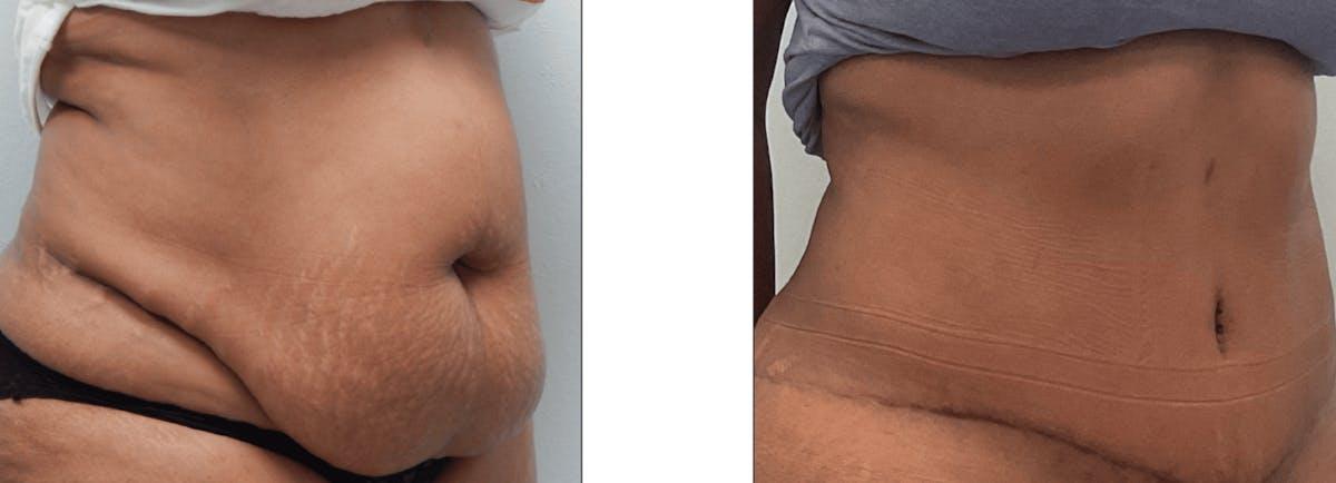 Fort Lauderdale Plastic Surgery tummy tuck result — Fort Lauderdale, FL